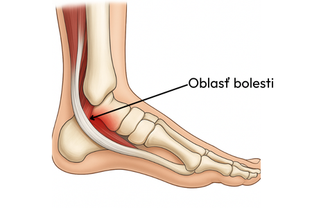 Syndróm tarzálneho tunela – anatómia nervu za vnútorným členkom